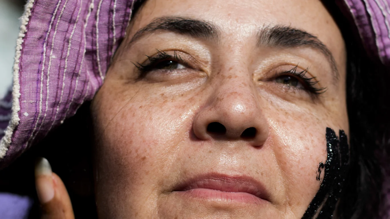 Tratamiento para manchas de sol en la cara en Weston Florida con IPL y Picoláser para unificar el tono de la piel