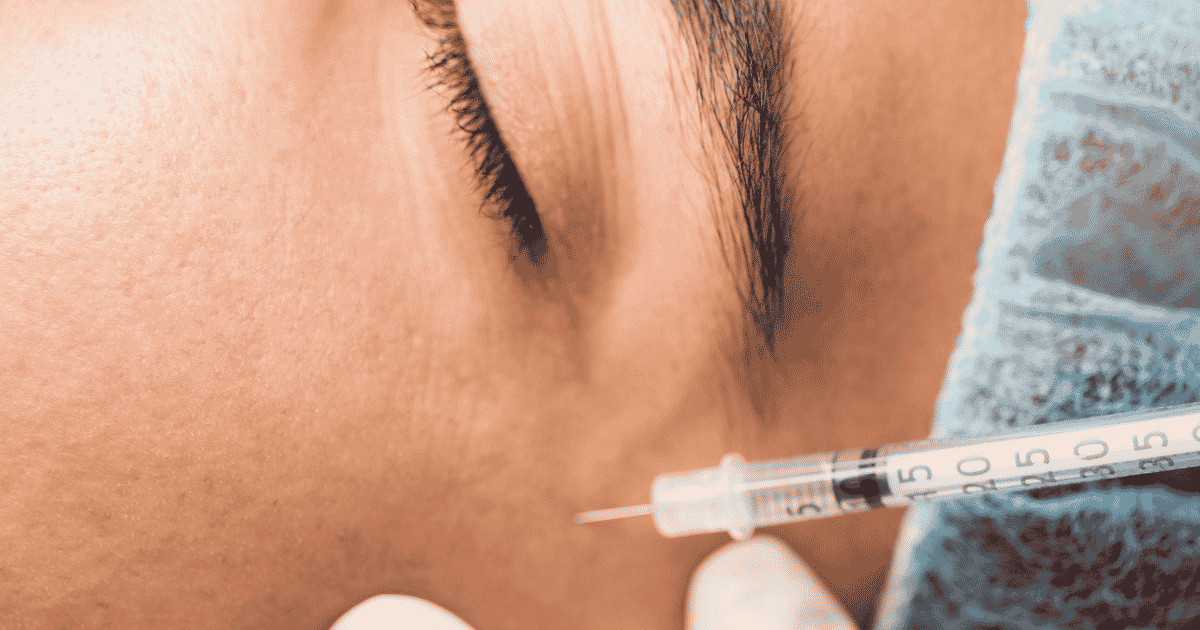 Definición de mandíbula y mentón con fillers en el rostro