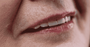 ¿Líneas de la sonrisa en las mejillas? Descubre por qué no se usa toxina en esa zona y cómo Radiesse hiperdiluido mejora la firmeza.